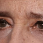 Blepharoplasty Before & After Patient #30271