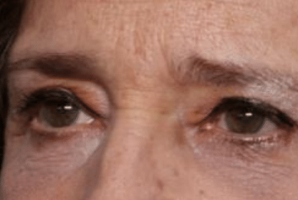 Blepharoplasty Before & After Patient #30271