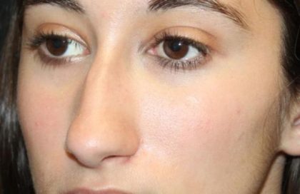 Rhinoplasty Before & After Patient #30321