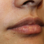 Lip Filler Before & After Patient #30185