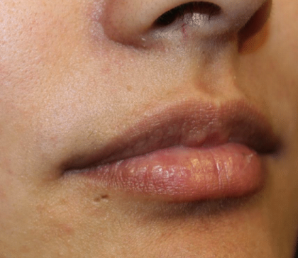 Lip Filler Before & After Patient #30185