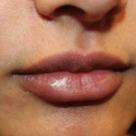 Lip Filler Before & After Patient #30185