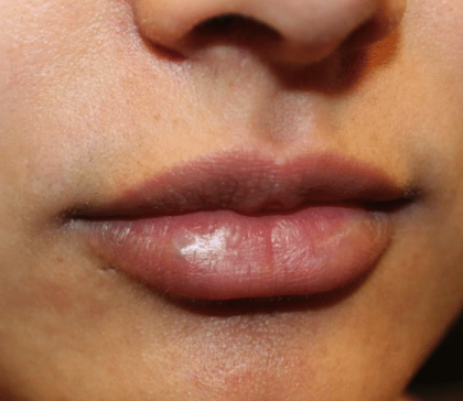 Lip Filler Before & After Patient #30185