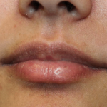 Lip Filler Before & After Patient #30185