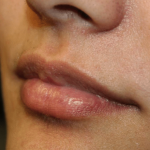 Lip Filler Before & After Patient #30185