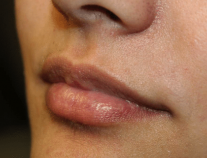 Lip Filler Before & After Patient #30185