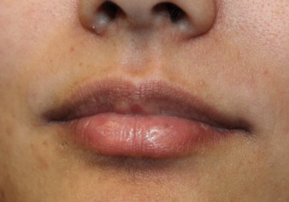 Lip Filler Before & After Patient #30185