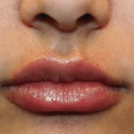 Lip Filler Before & After Patient #30185