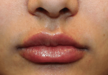 Lip Filler Before & After Patient #30185