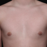 Gynecomastia Before & After Patient #30213