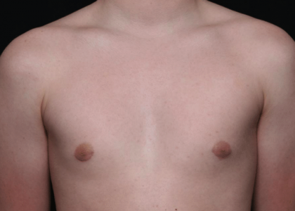 Gynecomastia Before & After Patient #30213