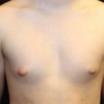 Gynecomastia Before & After Patient #30213