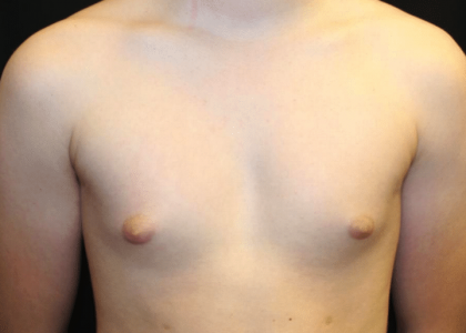 Gynecomastia Before & After Patient #30213