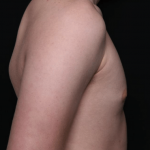 Gynecomastia Before & After Patient #30213