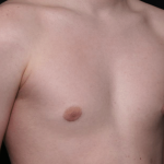 Gynecomastia Before & After Patient #30213