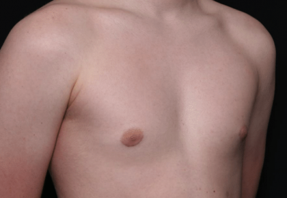 Gynecomastia Before & After Patient #30213