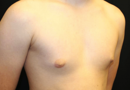 Gynecomastia Before & After Patient #30213