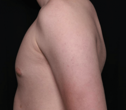 Gynecomastia Before & After Patient #30213