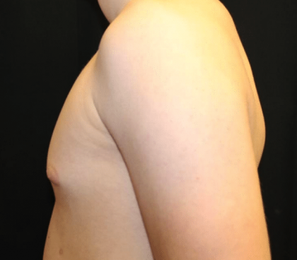 Gynecomastia Before & After Patient #30213