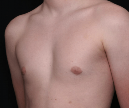 Gynecomastia Before & After Patient #30213