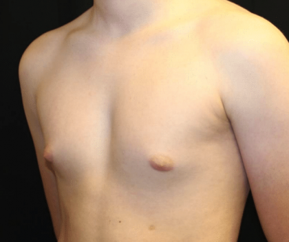 Gynecomastia Before & After Patient #30213