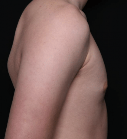 Gynecomastia Before & After Patient #30213