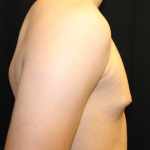 Gynecomastia Before & After Patient #30213