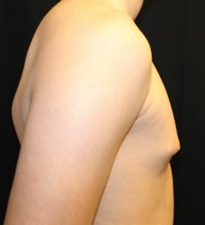 Gynecomastia Before & After Patient #30213