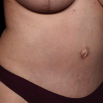 Tummy Tuck Before & After Patient #30246