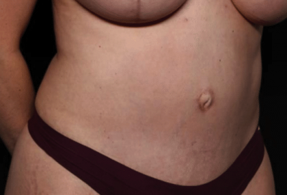 Tummy Tuck Before & After Patient #30246