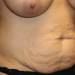 Tummy Tuck Before & After Patient #30246