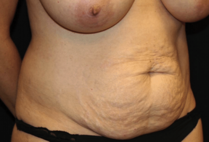 Tummy Tuck Before & After Patient #30246