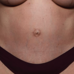 Tummy Tuck Before & After Patient #30246