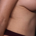 Tummy Tuck Before & After Patient #30246