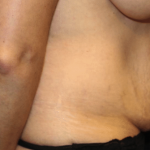 Tummy Tuck Before & After Patient #30246