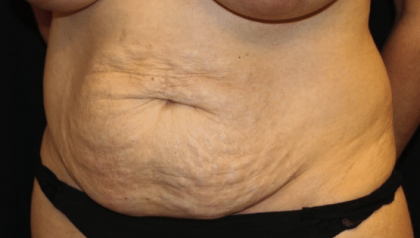 Tummy Tuck Before & After Patient #30246