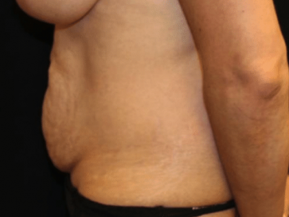 Tummy Tuck Before & After Patient #30246