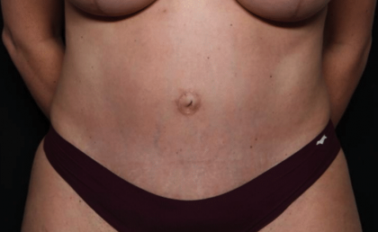 Tummy Tuck Before & After Patient #30246