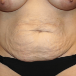 Tummy Tuck Before & After Patient #30246