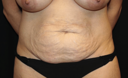 Tummy Tuck Before & After Patient #30246