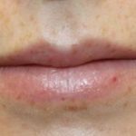 Lip Filler Before & After Patient #30341