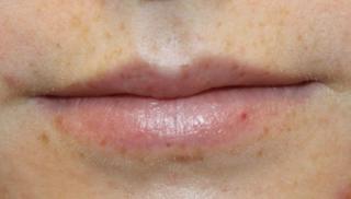 Lip Filler Before & After Patient #30341