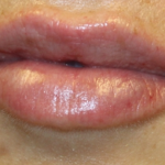 Lip Filler Before & After Patient #30358