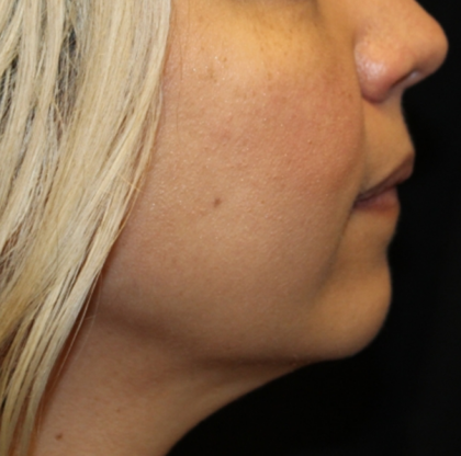 Injectable Fillers Before & After Patient #30408