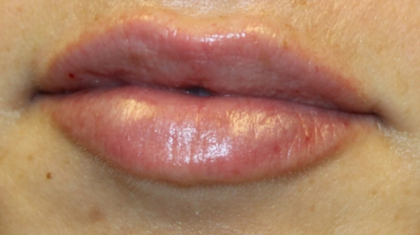 Lip Filler Before & After Patient #30358