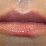 Lip Filler Before & After Patient #30426