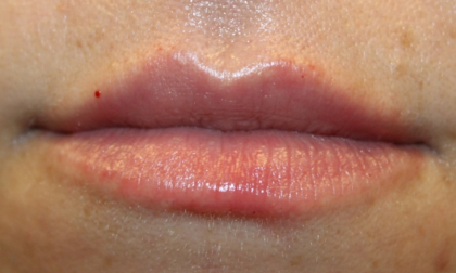 Lip Filler Before & After Patient #30426