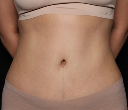 Tummy Tuck Before & After Patient #30433