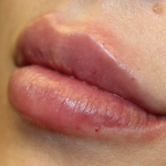 Lip Filler Before & After Patient #30466