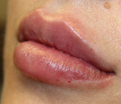 Lip Filler Before & After Patient #30466